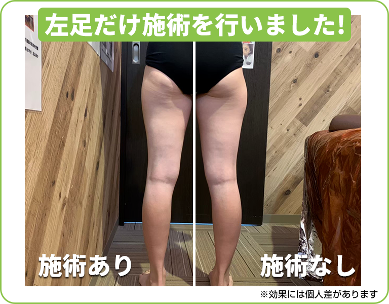 下半身痩せを体験した方のビフォーアフター