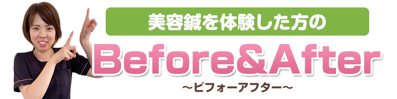 美容鍼ビフォーアフター