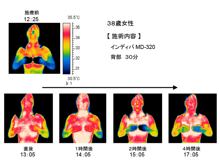 サーモグラフィー画像Ａ