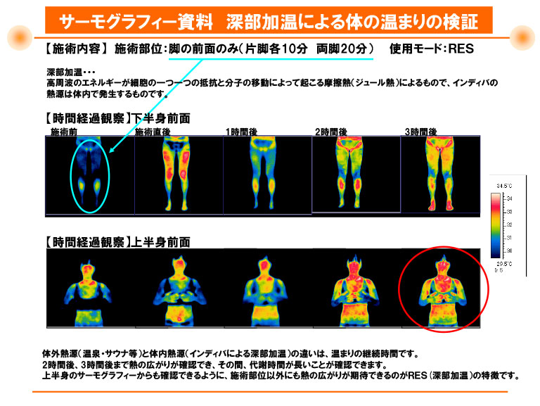 サーモグラフィー画像Ｂ